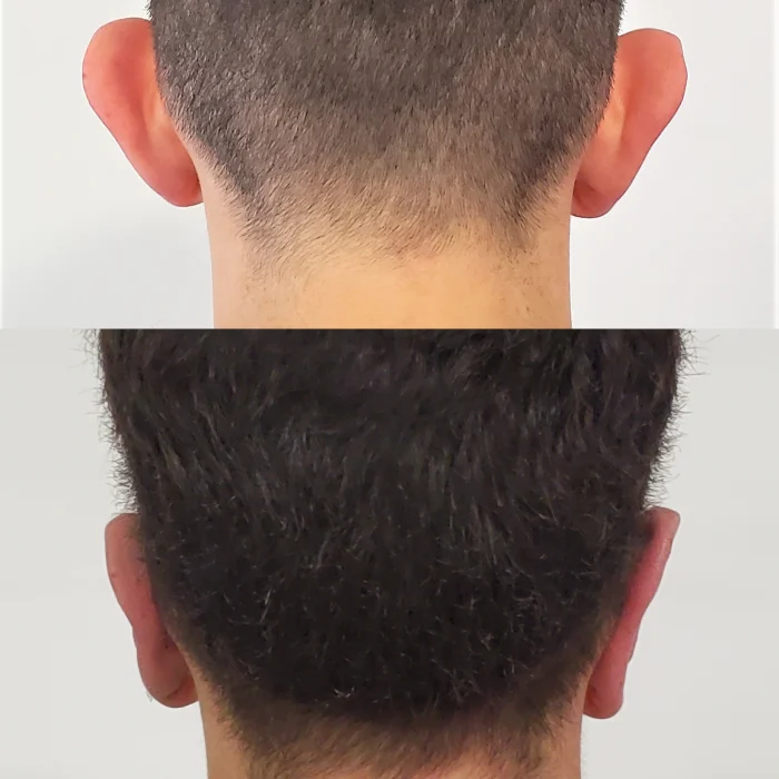 OTOPLASTIA-2-JPEG