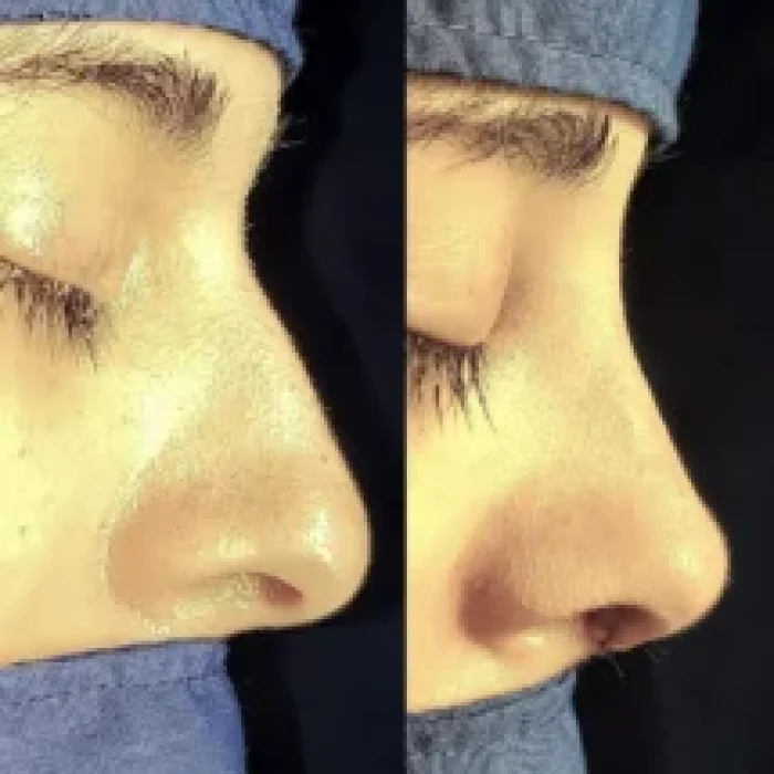 RINOPLASTIA-215x300